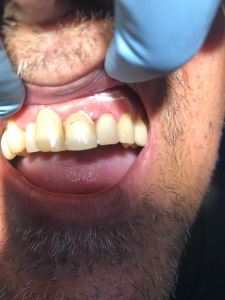 resconstrución diente